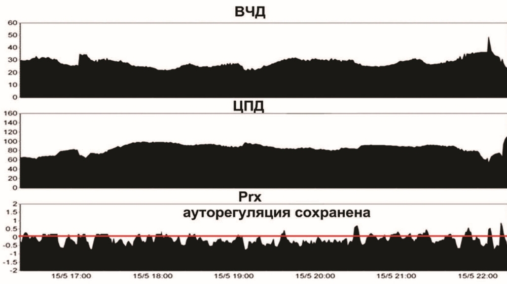 Рис. 2. Данные расширенного нейромониторинга на 3-и сутки после травмы